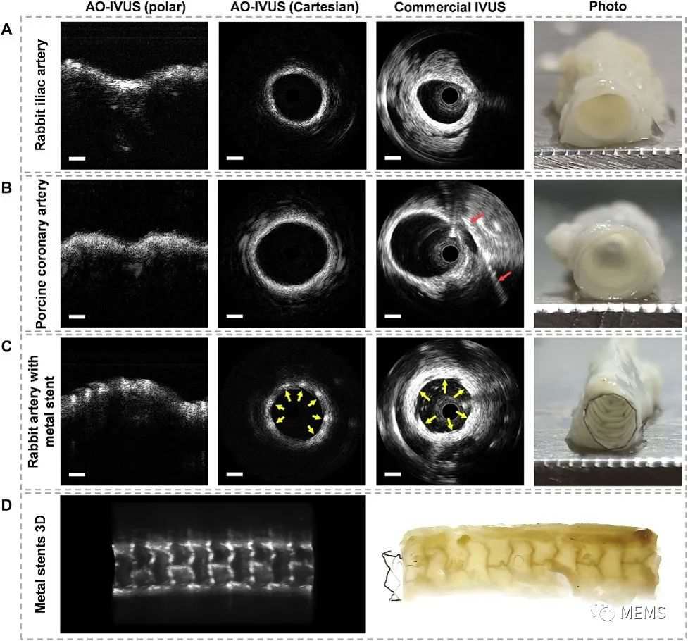 血管内超声（IVUS）成像系统在心血管疾病评估中的作用 (https://ic.work/) 医疗电子 第4张