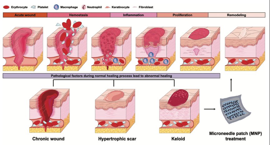 用于伤口和疤痕治疗的微针贴片研究进展 (https://ic.work/) 医疗电子 第1张