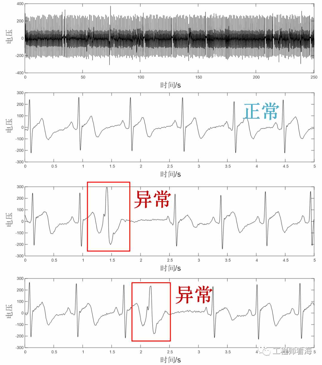 工程师生病了怎么办？自己做电路给自己测：ECG与心脏早搏 (https://ic.work/) 医疗电子 第3张